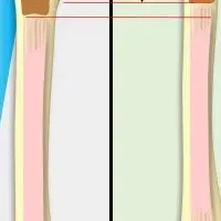 脊椎異形成症の研究